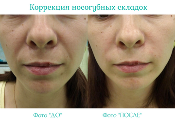 Контурная пластика - СОВЕРМЕД - многопрофильный медицинский центр г. Киров