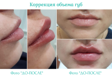 Объем Губ Фото До И После