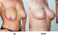 Подтяжка груди, изменение формы груди (мастопексия)