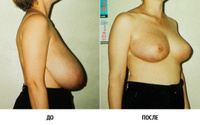 Уменьшение груди при гипермастии (редукционная маммопластика)